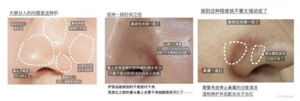 真正能帮你把鼻子彻底变干净的黑头三部曲