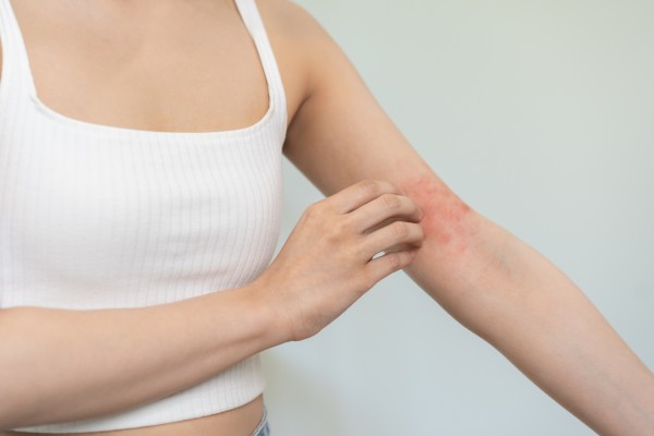 汗疹=痱子！長汗疹原因？會自己好嗎？藥膏、消除方法一次看