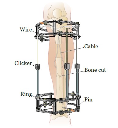 About Your External Fixator (Ex Fix)