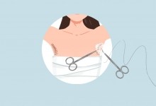 闺蜜为1万中介费诱导其隆胸 女子术后感染致左胸部分切除