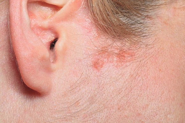 角化性足癣治疗攻略：多管齐下疗效好