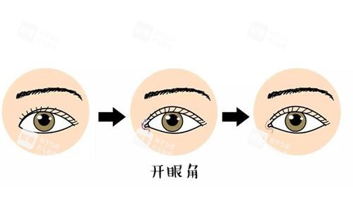 开眼角前后对比漫画图