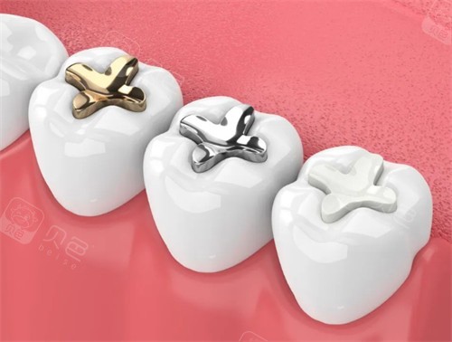 不同材质的补牙材料