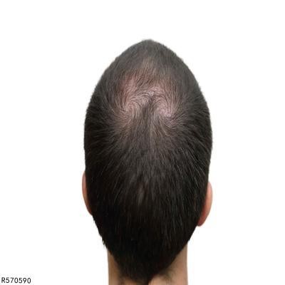 头顶长硬包像骨头凸起怎么回事