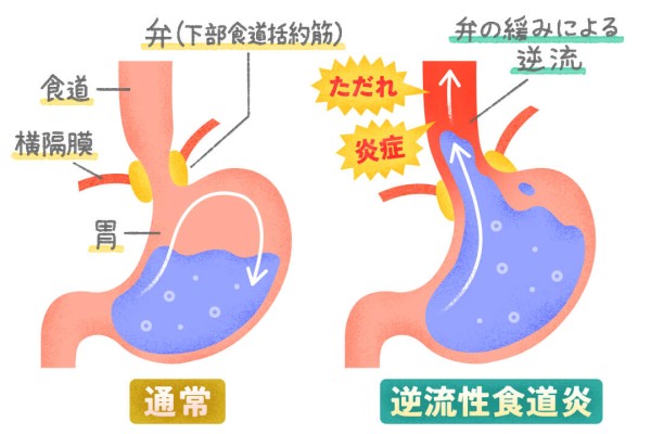 近年増加中！咳の原因にもなる「逆流性食道炎」