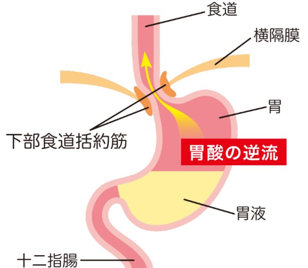 逆流性食道炎の原因