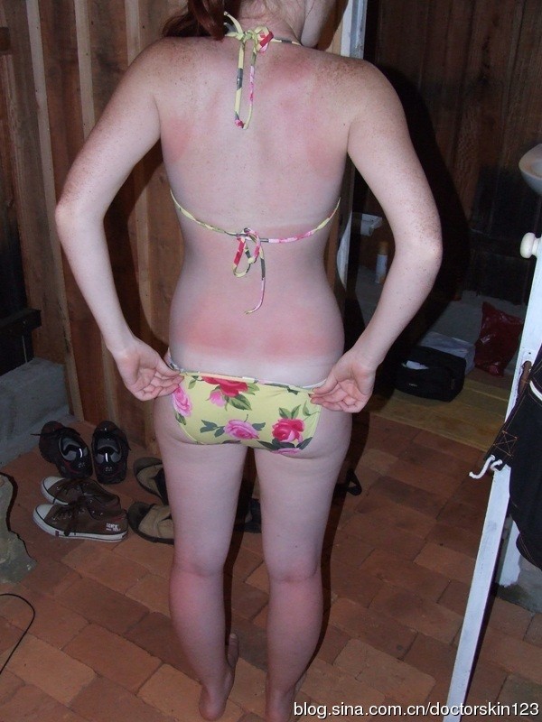 愚蠢的省钱法！谈「居家杏仁酸DIY」=广告/新闻阅读