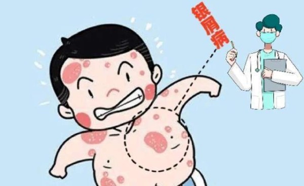 银屑病究竟怎么回事？能根治吗？日常如何护理？