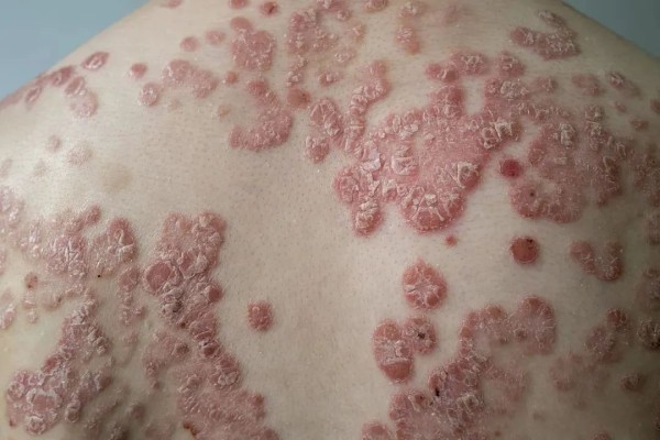 「不死的癌症」——银屑病